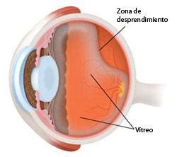 Desprendimiento del vitreo Centro Oftalmológico de Navarra