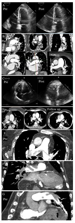 Safety And Effectiveness Of Lower Alteplase Dose Driven By Impending