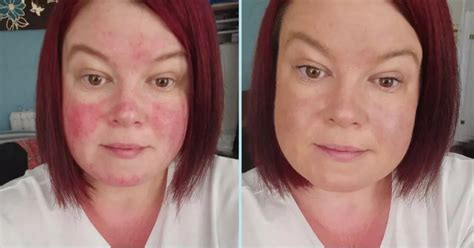 Rosaliques 3 In 1 Anti Redness Miracle Formula Hailed As Best Ever