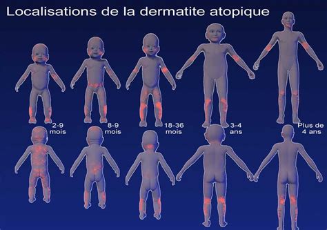 Dermato Info La Dermatite Atopique