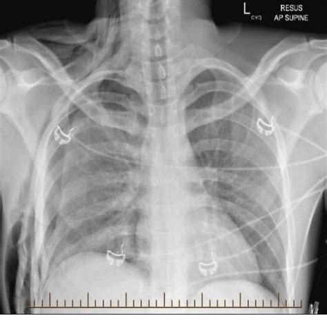 PDF Double Rib Sign On Computed Tomography Of The Chest Indication