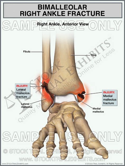 Bimalleolar Right Ankle Fracture – Stock Trial Exhibits