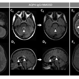 PDF Myelin Oligodendrocyte Glycoprotein Antibody Associated Disease