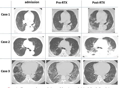 Figure 1 From Dermatomyositis With Rapidly Progressive Interstitial