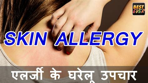 एलर्जी के घरेलू उपचार Home Remedies For Skin Allergy Youtube