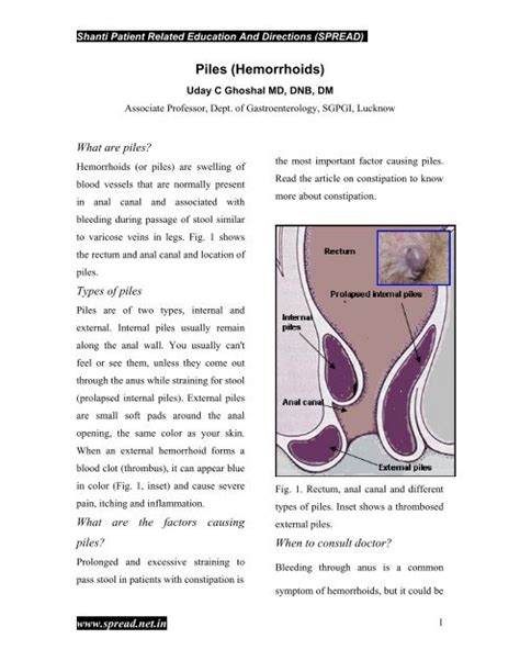 Thrombosed External Hemorrhoid How To Get Rid Of Hemorrhoids Types