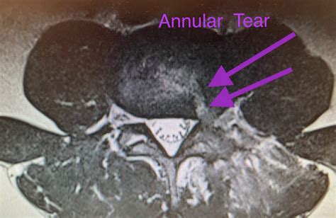 Annular Tear Treatment And Surgery Diagnosing Annular Disc Tears