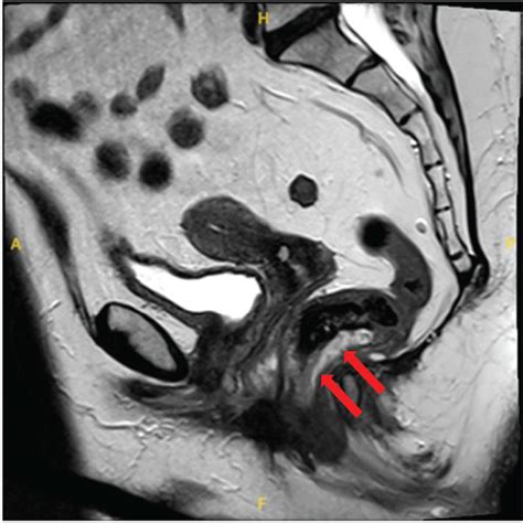 Pelvic Mri 13 Months Later With A Sagittal T2 Weighted Image A And An