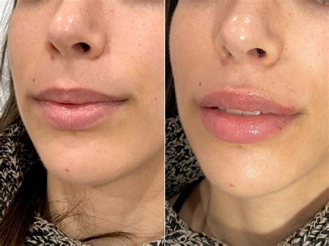 Lip Fillers Boise Fuller Lips Enhancement