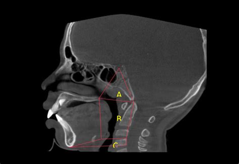 Fig Boundaries Of Divisions Of Pharyngeal Airway A