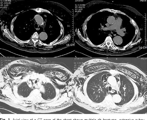 Figure 1 From Management Of Extensive Subcutaneous Emphysema With