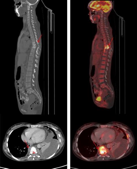 Ct Left Panel And 18f Fdg Petct Fused Images Right Panel