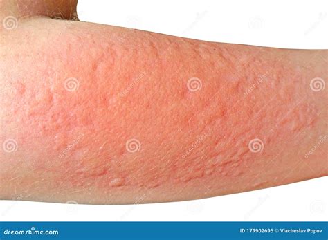 Allergic Reaction on the Skin Stock Image - Image of contact, care ...