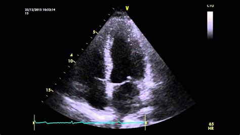 Apical 4 Chamber View Of A Normal Heart Youtube