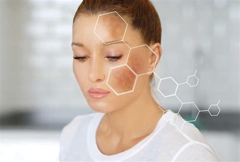 Melasma Síntomas Causas Y Tratamiento Blog Doctorgo