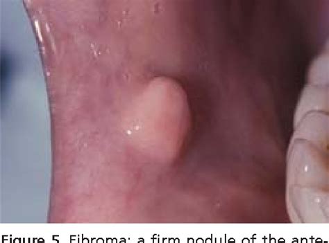 Pdf Common Oral Lesions Part Ii Masses And Neoplasia Semantic