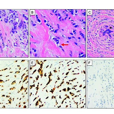 Classical Morphology And Immunophenotype Of Invasive Lobular