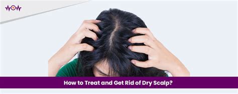 How To Treat And Get Rid Of Dry Scalp Wow Health Pakistan