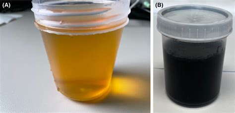 (A, B): Light yellow urine sample at time 0 (A); black urine after ...