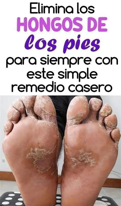 Truco Simple Y Natural Para Pies Secos Y Agrietados Remedio Hongos