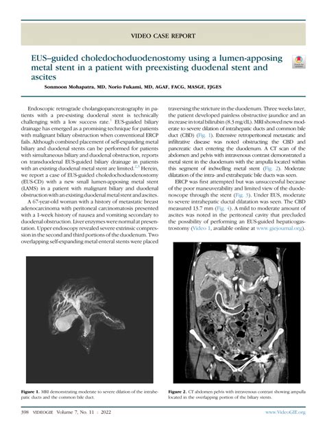 PDF EUSguided Choledochoduodenostomy Using A Lumen Apposing Metal