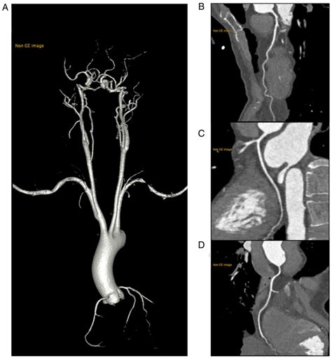 Ultralow Dose Onestep Ct Angiography For Coronary Carotid And