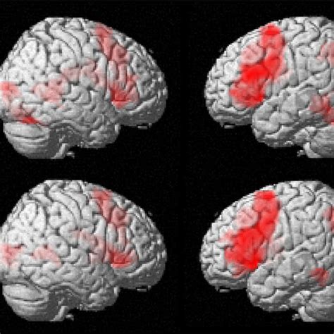 Illustrates Task Related FMRI Results Surface Renderings Of Bilateral