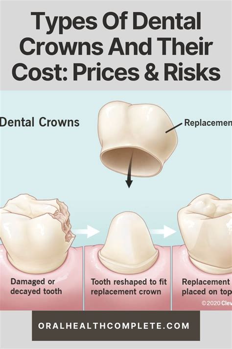 Types Of Dental Crowns Prices Materials And Risks