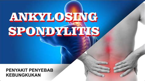 ANKYLOSING SPONDYLITIS PERADANGAN PADA SENDI YANG MEMBUAT ANDA SULIT