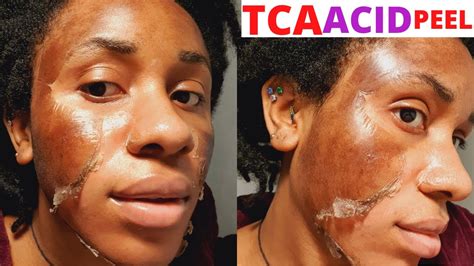 Diy Tca Peel At Home Day By Day Progress On Black Skin Youtube