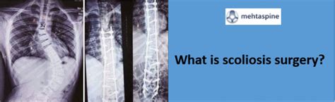 What Is Scoliosis Surgery Dr Jwalant S Mehta Spinal Surgeon Uk