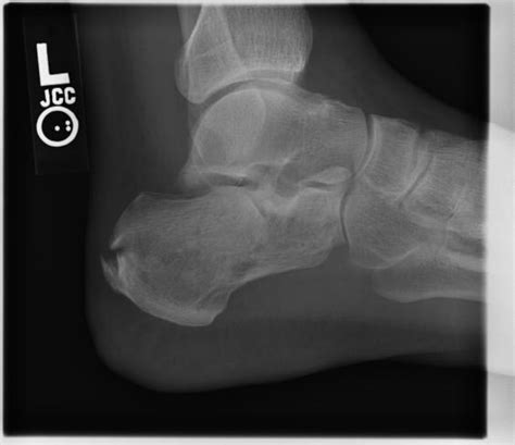 Calcaneal Fracture Wikidoc