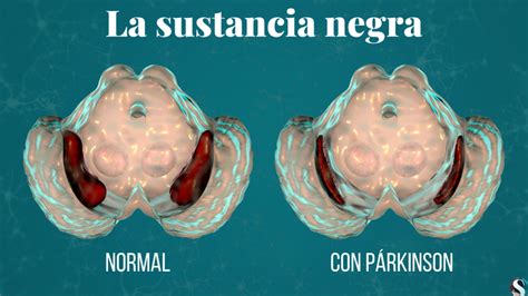 Parkinson qué es síntomas fases de la enfermedad y tratamientos