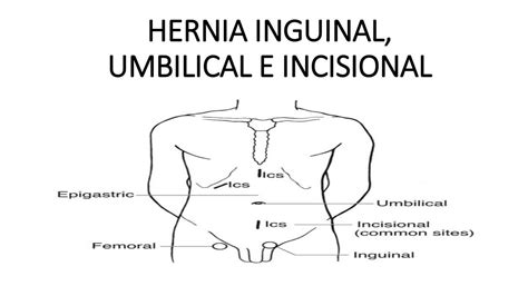 Res Menes De Hernias Inguinales Descarga Apuntes De Hernias Inguinales