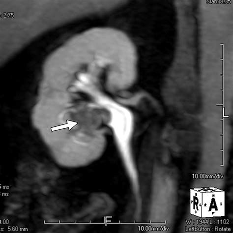 Mr Urography Techniques And Clinical Applications Radiographics