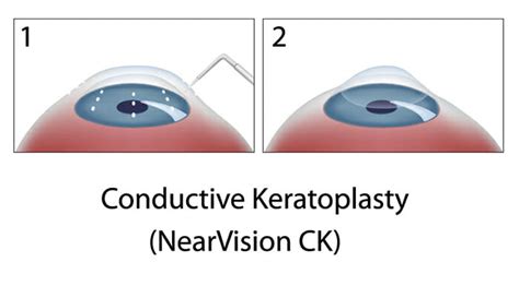 CK Fort Worth | Conductive Keratoplasty Fort Wort | Texas Eye