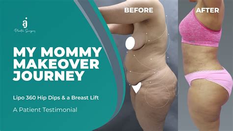 Mommy Make Over Lipo Hip Dips A Breast Lift Youtube