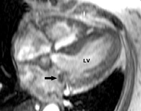 Mr Imaging Of Cardiac Tumors Radiographics