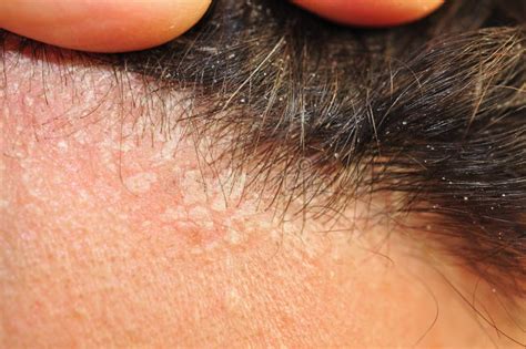 Seborrheic Dermatitis Fungal Skin Infection Scalp Southeast