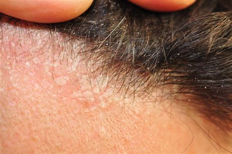 Seborrheic Dermatitis Scalp