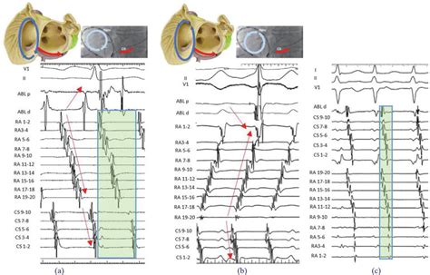 Atrial Flutter Diagnosis And Management Strategies IntechOpen