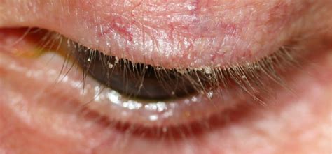 Blepharitis And Demodex Mites Ungex Demodex Treatment