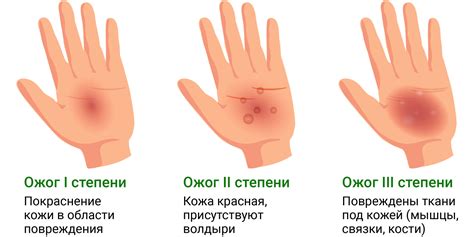 Мази и кремы от ожогов: антисептические, заживляющие, от рубцов