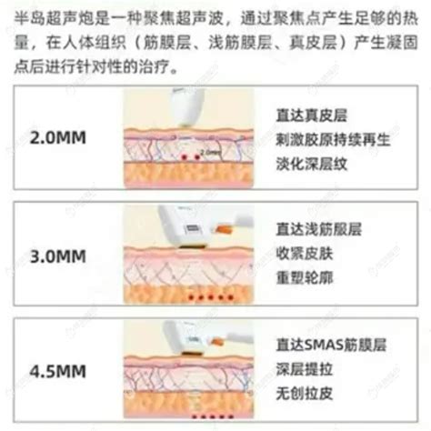 半岛超声炮做全脸一次价格表一览 做300发 500发 1000发的费用不同整形案例 毕节利美康医疗美容门诊部 炫美网