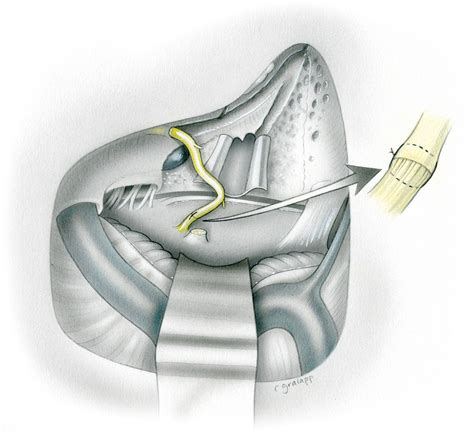 Facial Nerve Repair Skull Base Surgery Atlas