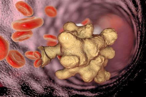 Entamoeba Histolytica Causes