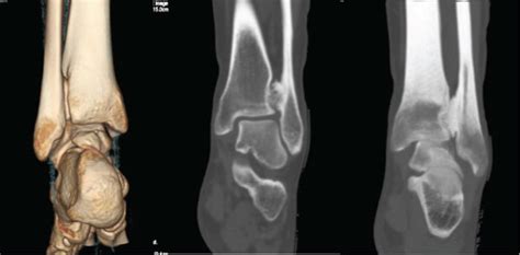 Preoperative A Ct Scan With Three Dimensional Reconstruction And One