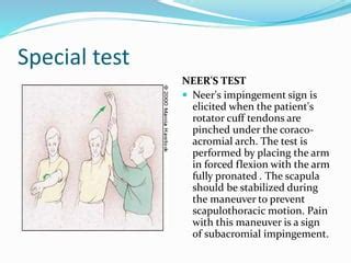 Painful Shoulder Arc PPT