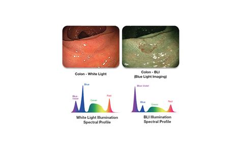 Interventional Gastro Video Imaging System Fujifilim ELUXEO