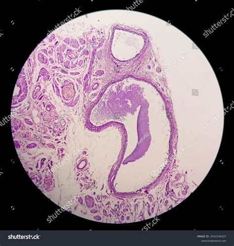 Histology Peritoneal Inclusion Cyst Paraovarian Cysts Stock Photo ...